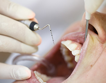 Severe periodontal disease