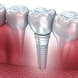 Dental Implants in Ithaca, NY