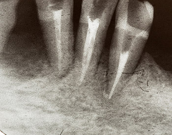 Bone resorption