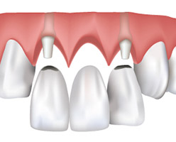 Dental Bridges in Ithaca, NY