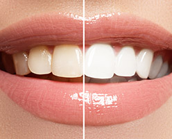 Laser Teeth Whitening in Ithaca, NY