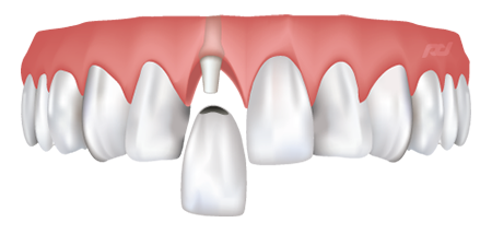 Dental Crowns in Ithaca, NY