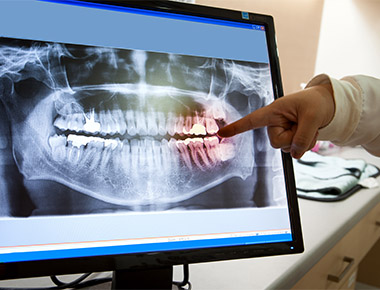 Dental X-Rays in Ithaca, NY