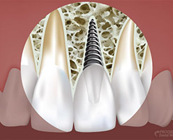 Dental Implants in Ithaca, NY