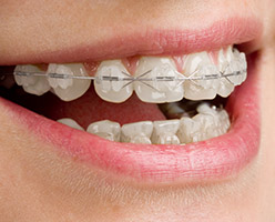 Orthodontics in Ithaca, NY