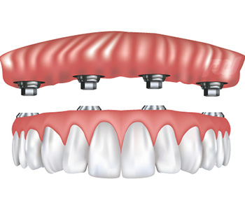 Implant Supported Dentures in Ithaca, NY