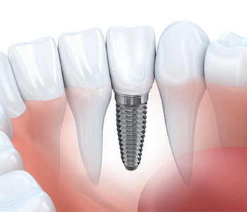 Dental Implants in Ithaca, NY