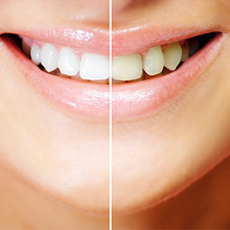 Teeth Whitening in Ithaca, NY