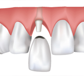 Dental Crown in Ithaca, NY